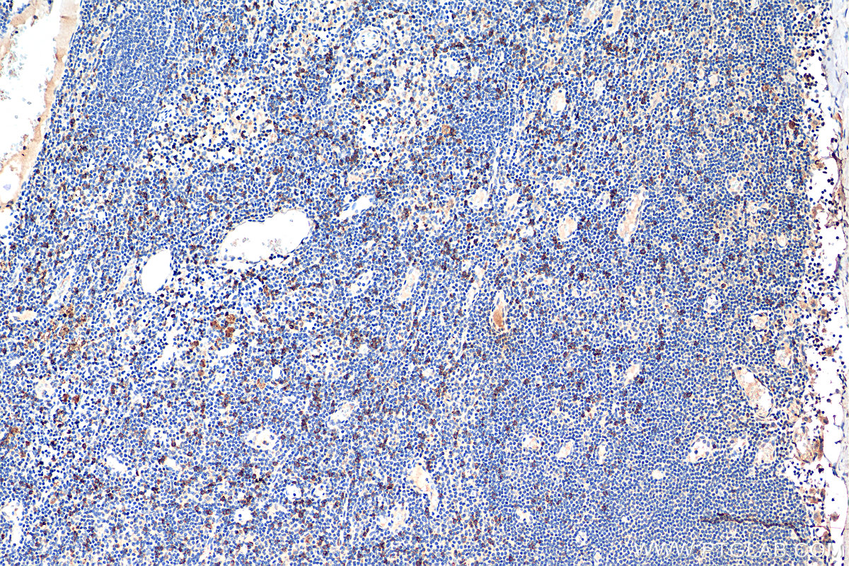 IHC staining of human breast cancer using 68432-1-Ig