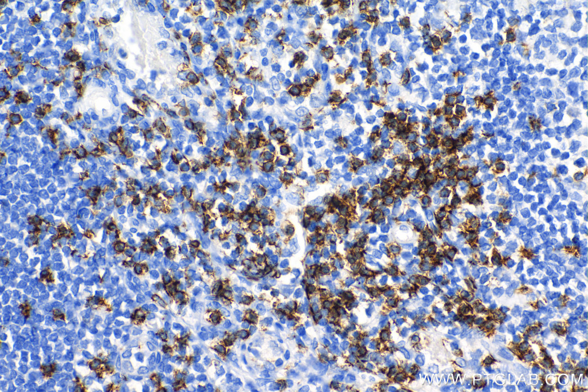 IHC staining of human tonsillitis using 86063-2-RR