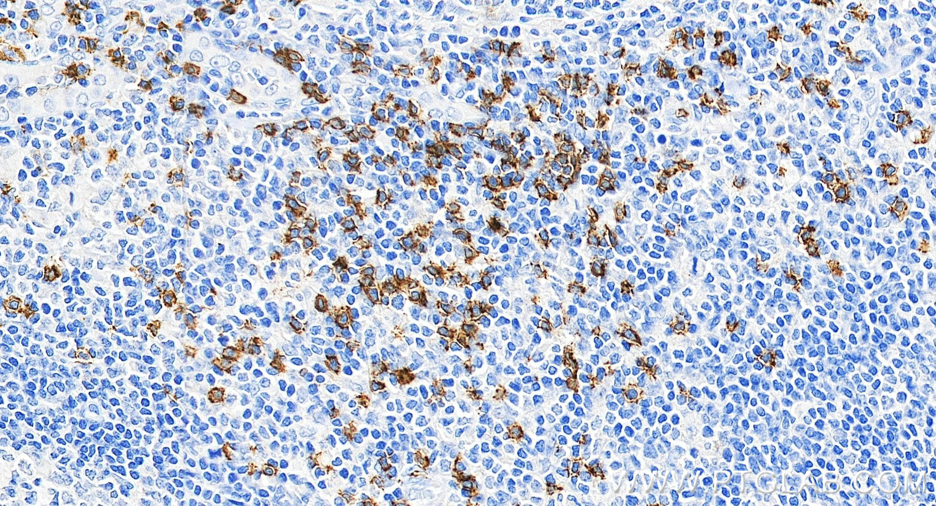 IHC staining of human tonsillitis using 86063-2-RR