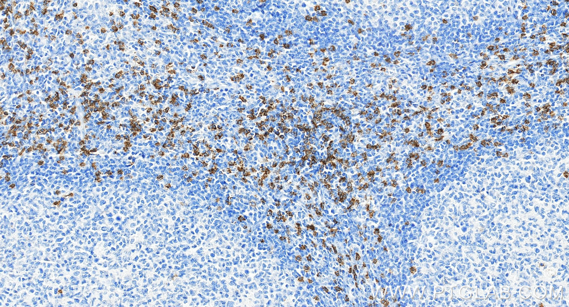 IHC staining of human tonsillitis using 98470-2-RR (same clone as 98470-2-PBS)