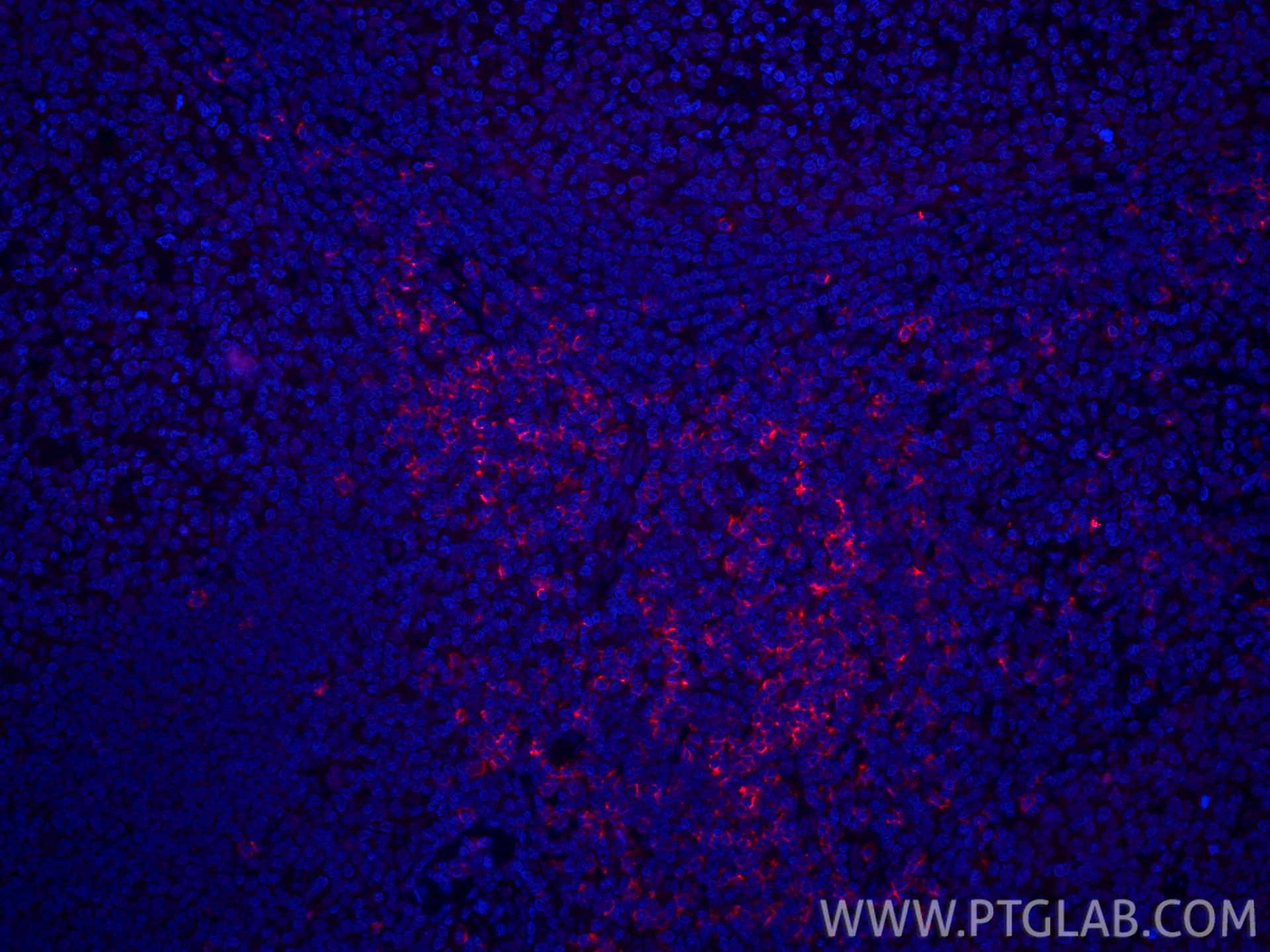 IF Staining of human tonsillitis using CL594-86063-2 IF Staining of human tonsillitis using CL594-86063-2