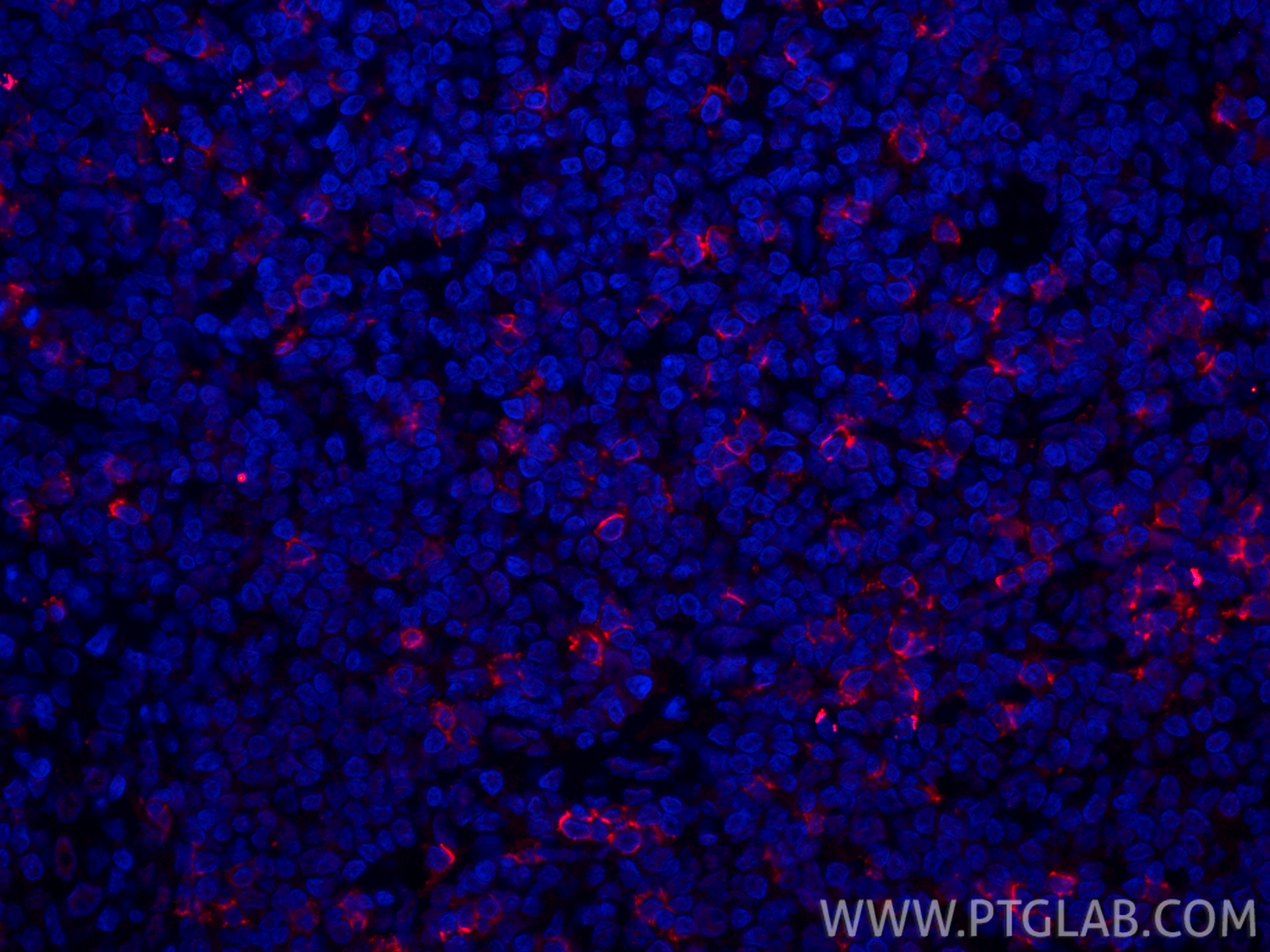 IF Staining of human tonsillitis using CL594-86063-2 IF Staining of human tonsillitis using CL594-86063-2