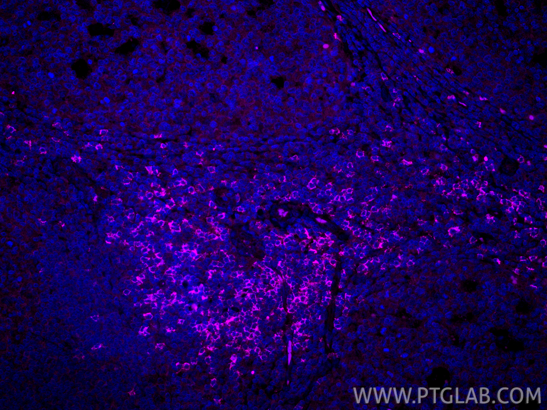 IF Staining of human tonsillitis using CL647-86063-2 IF Staining of human tonsillitis using CL647-86063-2