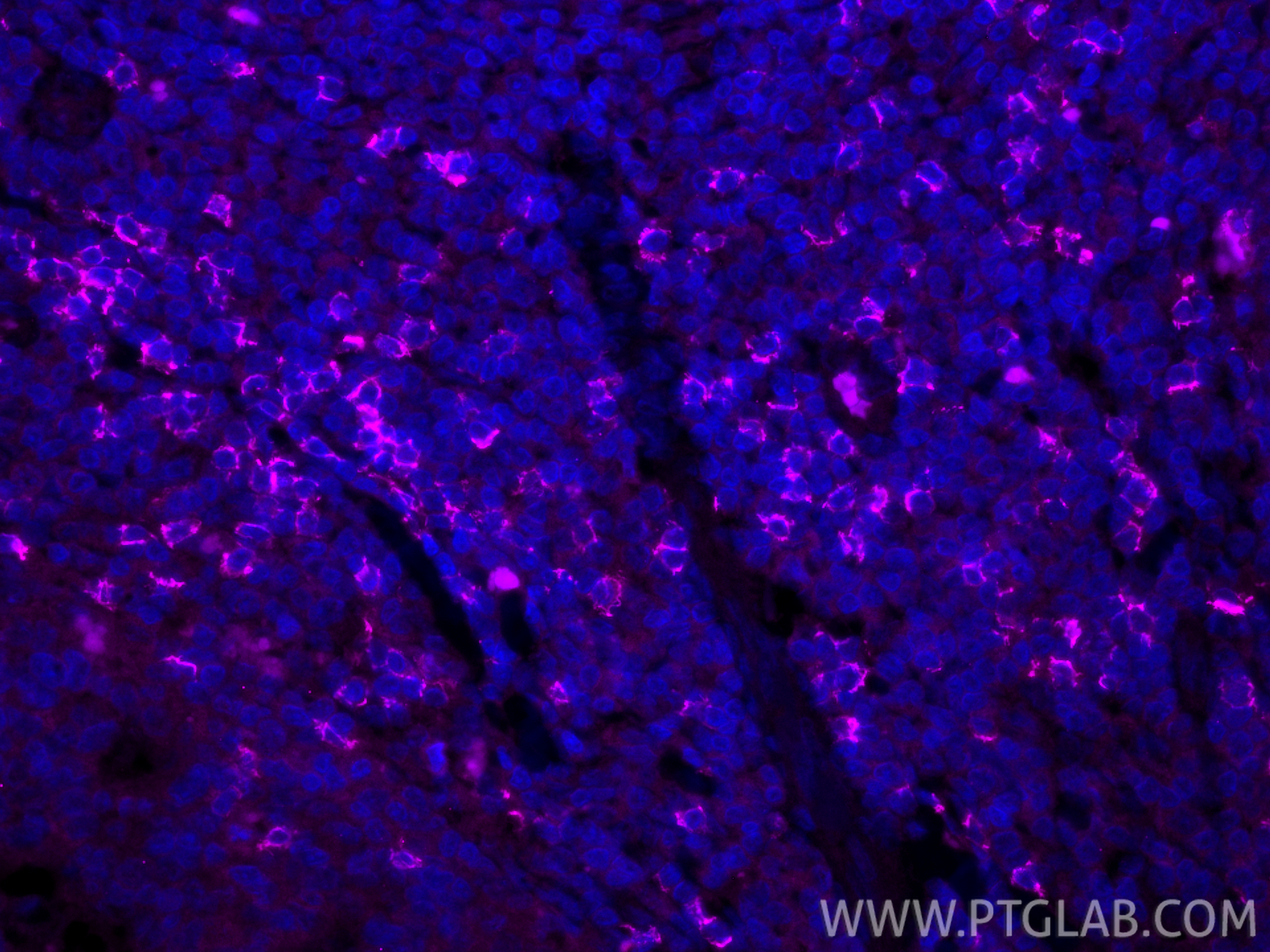 IF Staining of human tonsillitis using CL647-86063-2 IF Staining of human tonsillitis using CL647-86063-2
