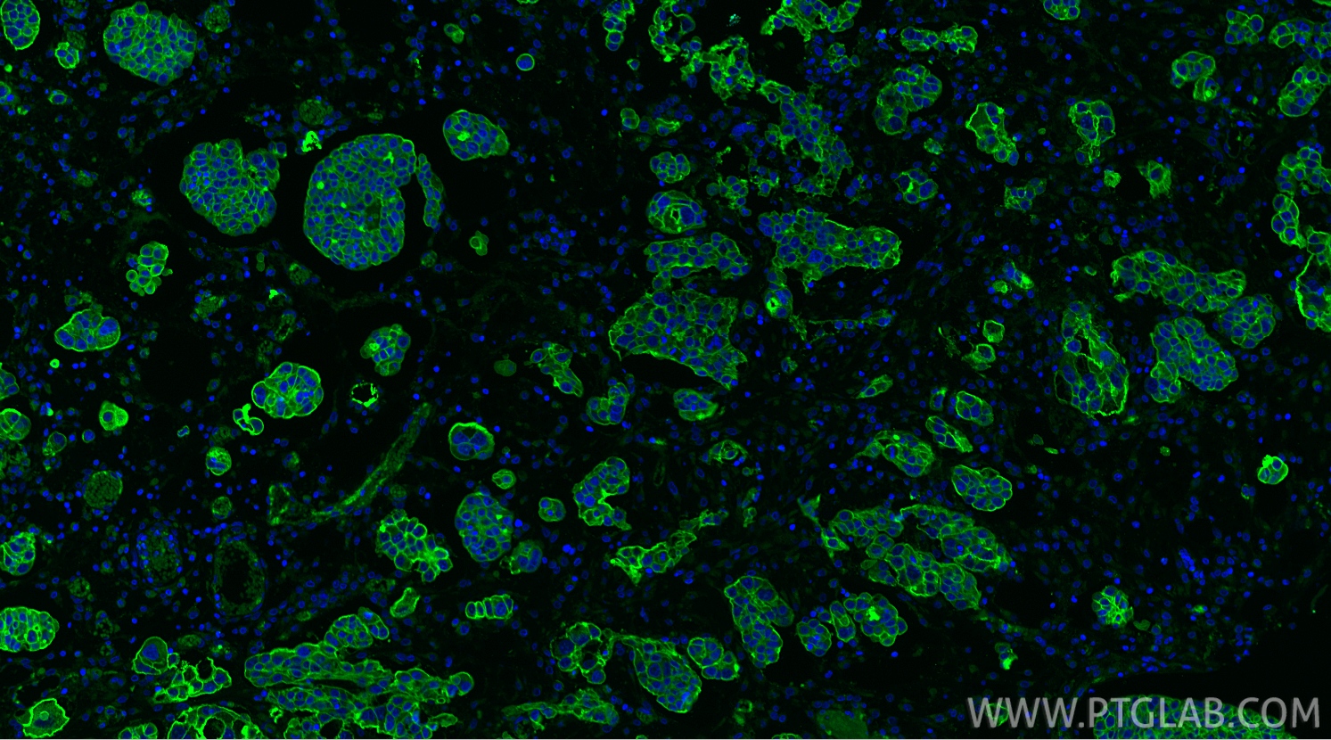 IF Staining of human ovary cancer using 20597-1-AP IF Staining of human ovary cancer using 20597-1-AP