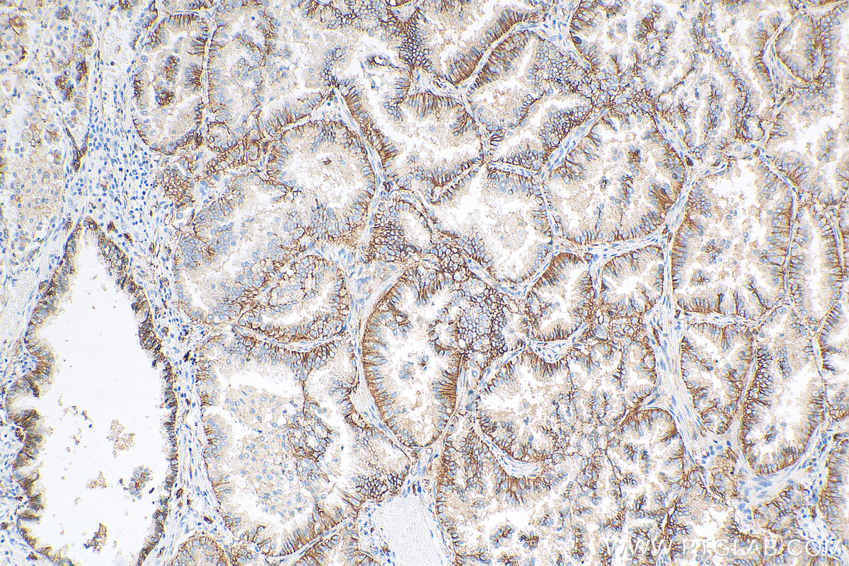 IHC staining of human lung cancer using 20597-1-AP