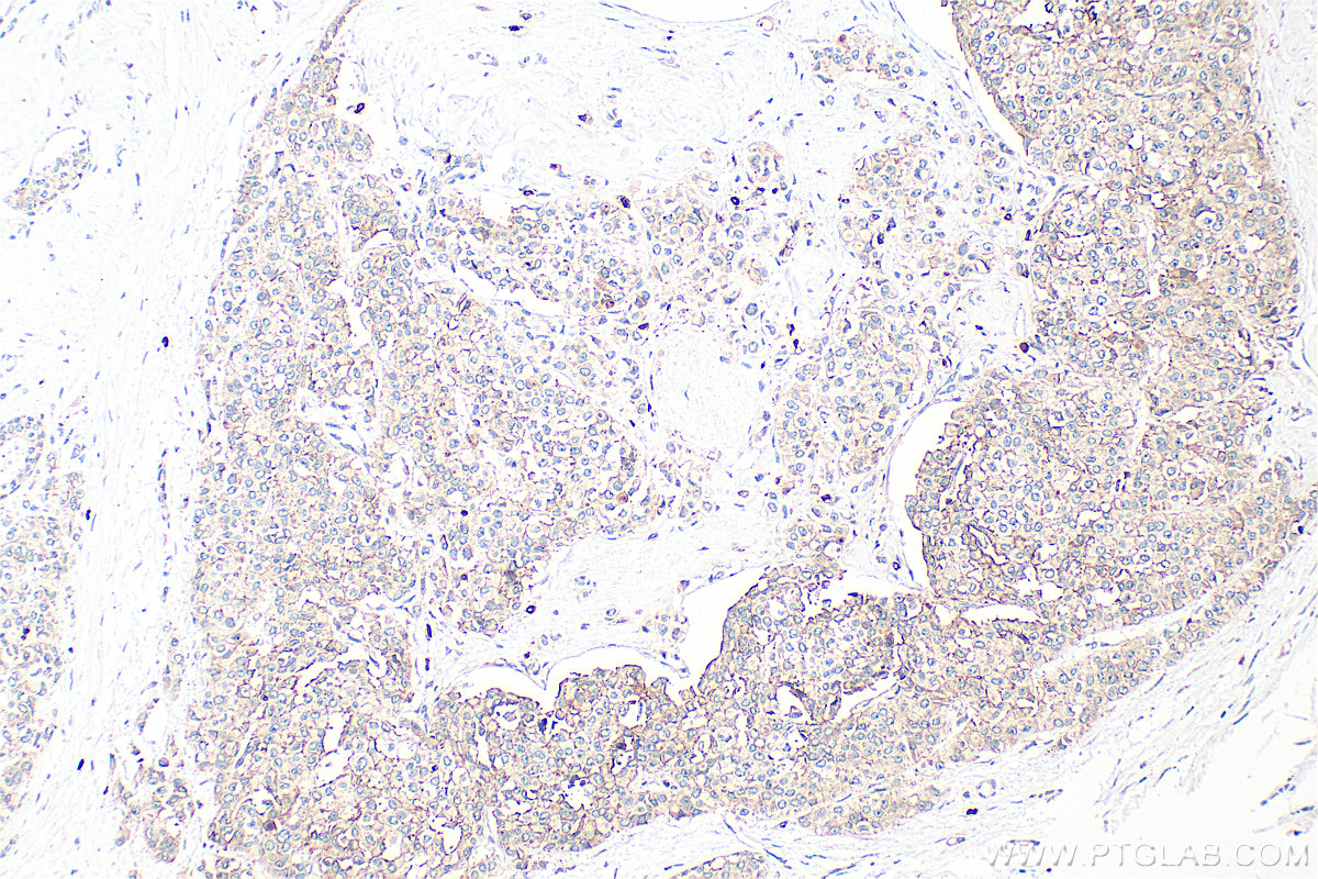Immunohistochemical analysis of paraffin-embedded human breast cancer tissue slide using 31514-1-AP (CD9 antibody) at dilution of 1:400 (under 10x lens). Heat mediated antigen retrieval with Tris-EDTA buffer (pH 9.0). IHC staining of human breast cancer using 31514-1-AP
