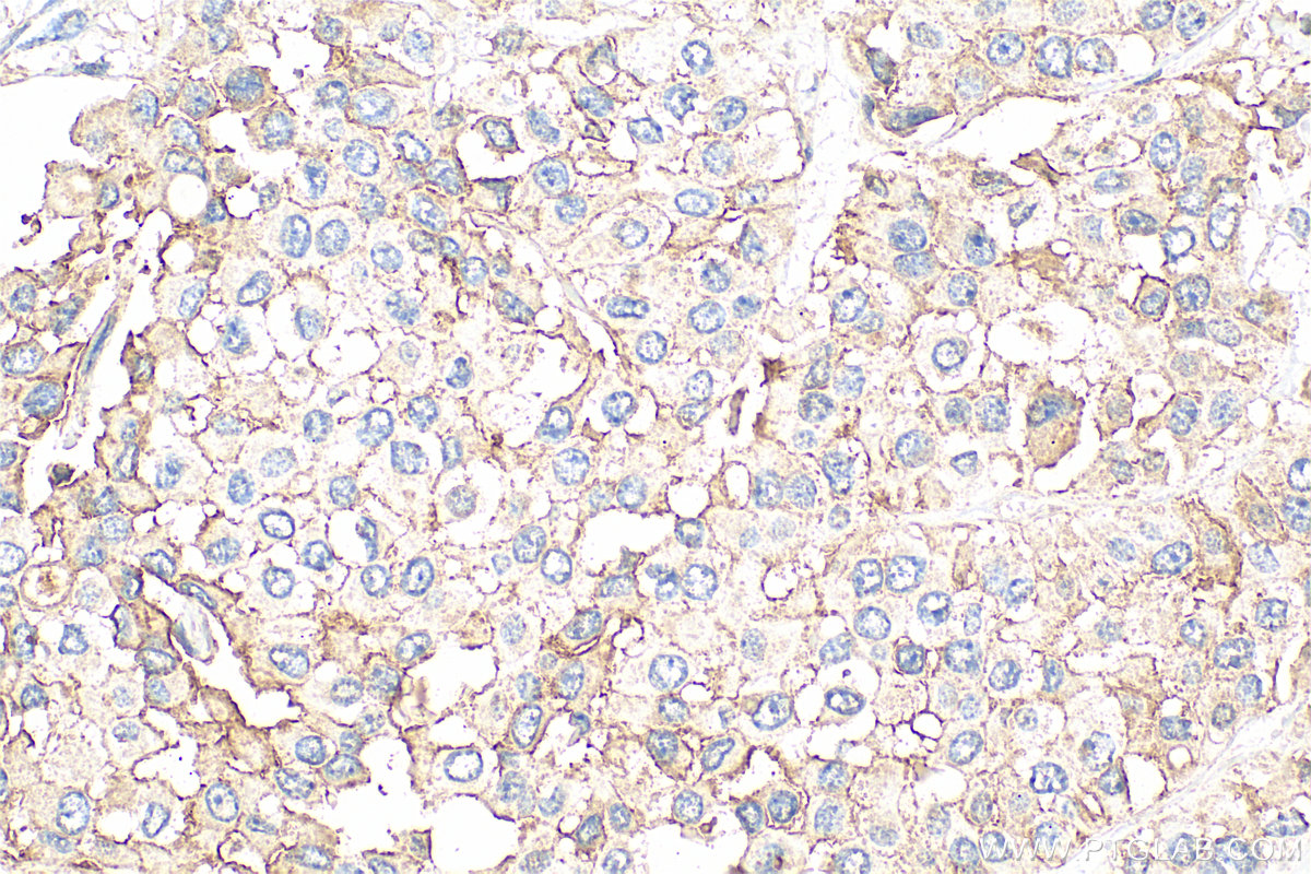 Immunohistochemical analysis of paraffin-embedded human breast cancer tissue slide using 31514-1-AP (CD9 antibody) at dilution of 1:400 (under 40x lens). Heat mediated antigen retrieval with Tris-EDTA buffer (pH 9.0). IHC staining of human breast cancer using 31514-1-AP