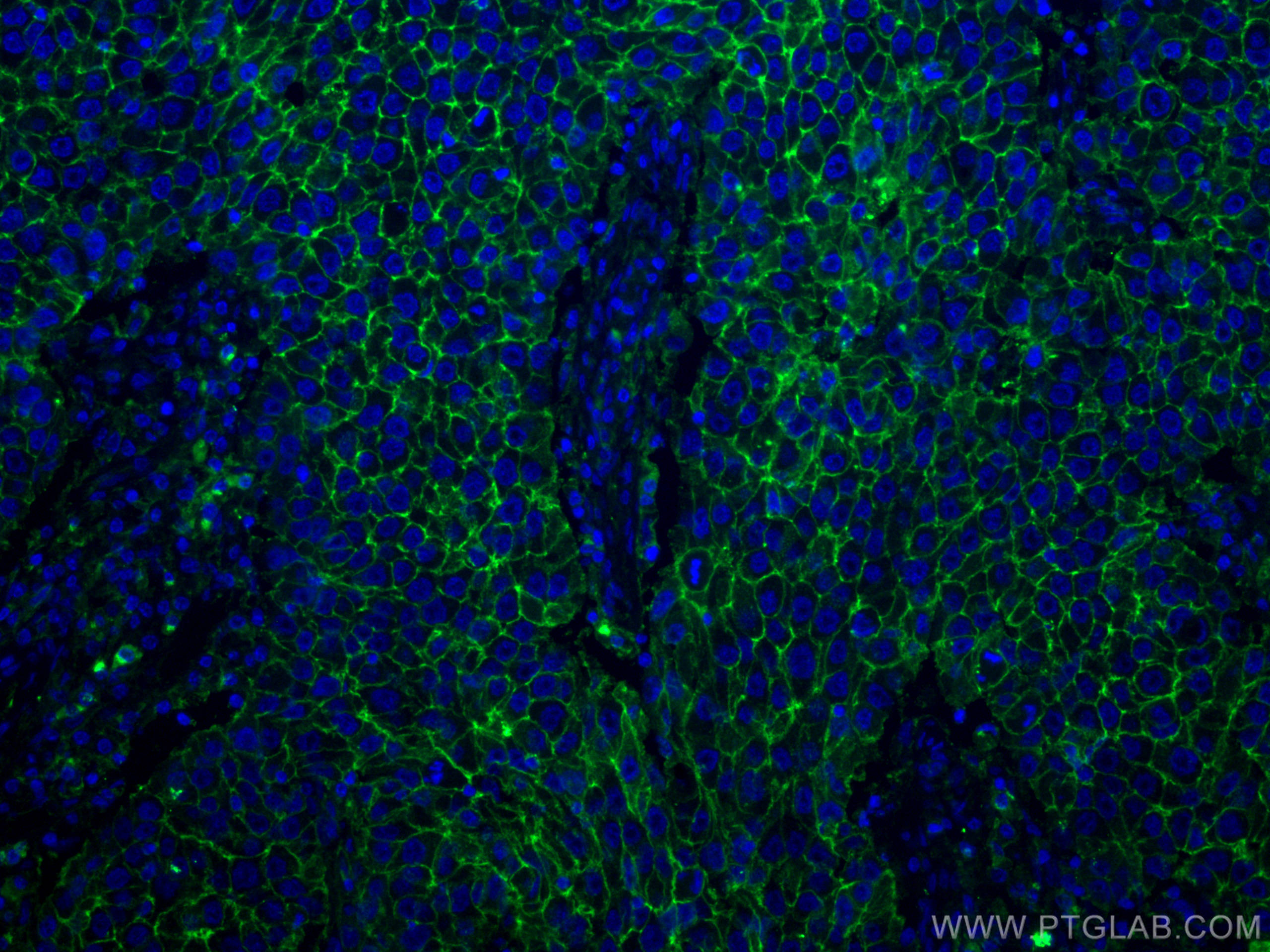 IF Staining of human breast cancer using 60232-1-Ig