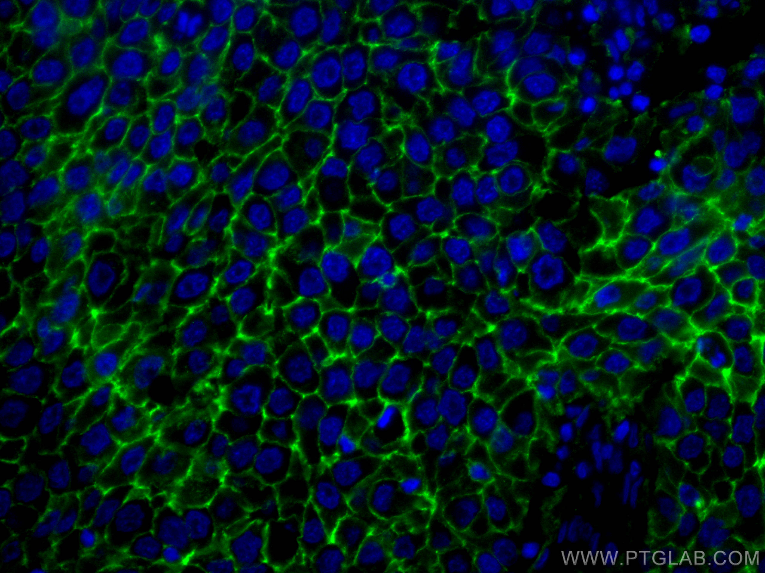 IF Staining of human breast cancer using 60232-1-Ig (same clone as 60232-1-PBS)