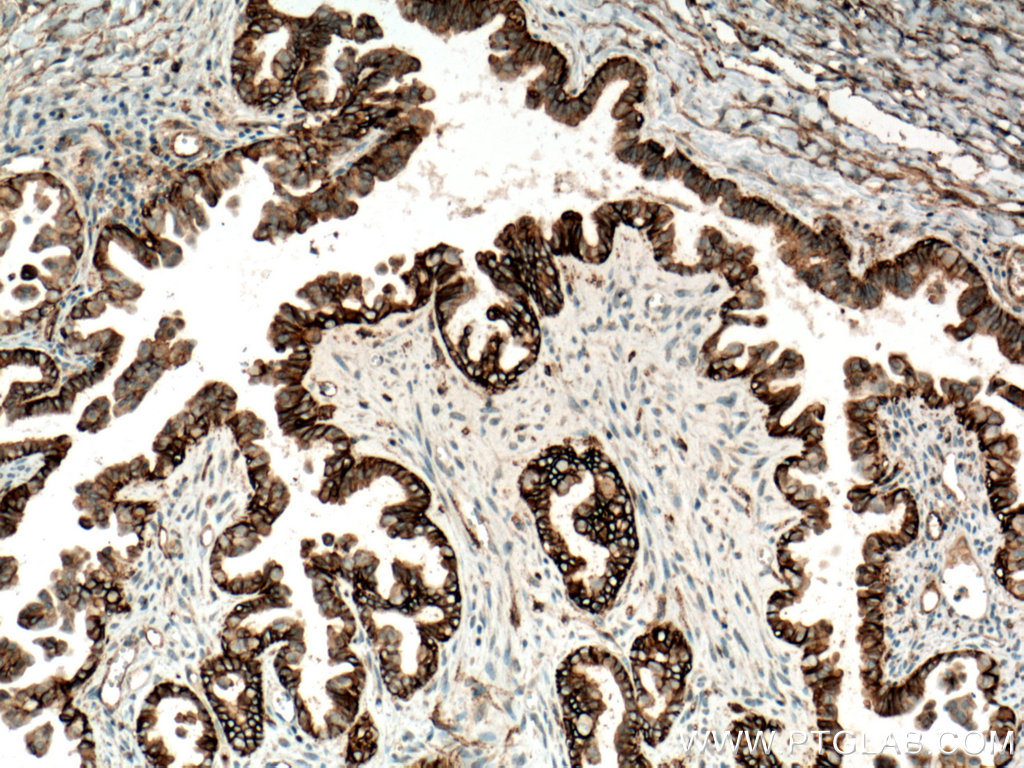 IHC staining of human ovary tumor using 60232-1-Ig (same clone as 60232-1-PBS)