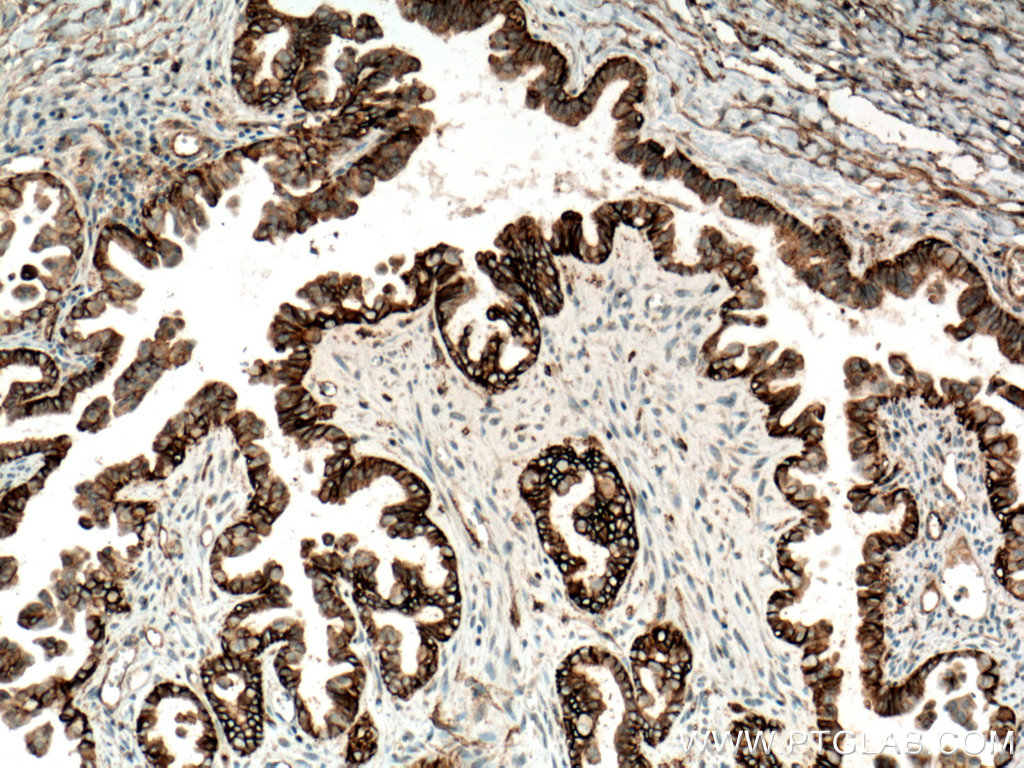 IHC staining of human ovary tumor using 60232-1-Ig