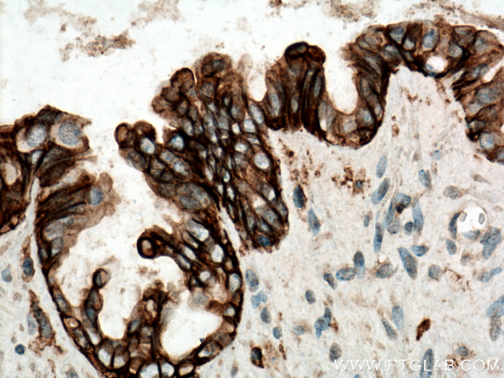 IHC staining of human ovary tumor using 60232-1-Ig (same clone as 60232-1-PBS)