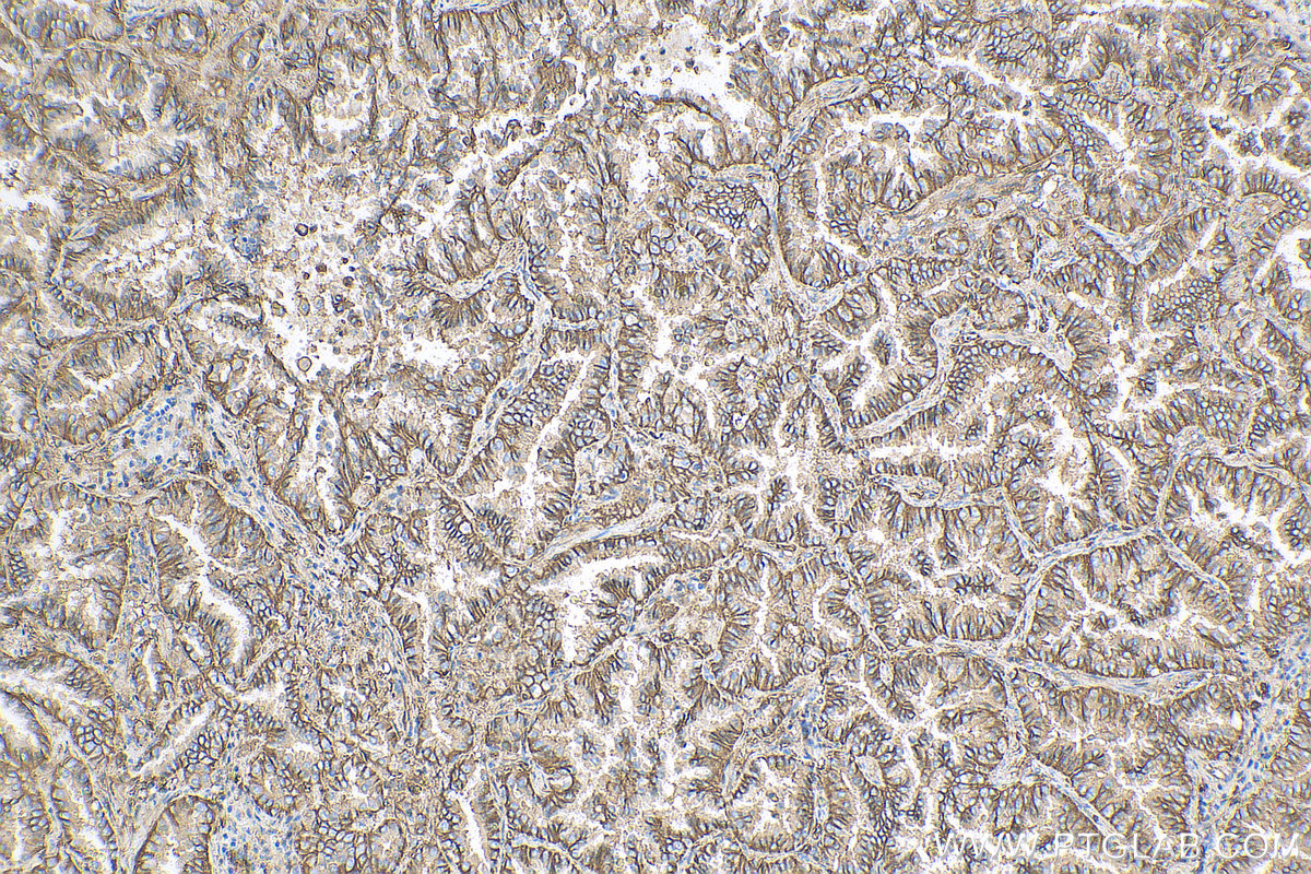 IHC staining of human lung cancer using 82105-1-RR (same clone as 82105-1-PBS)