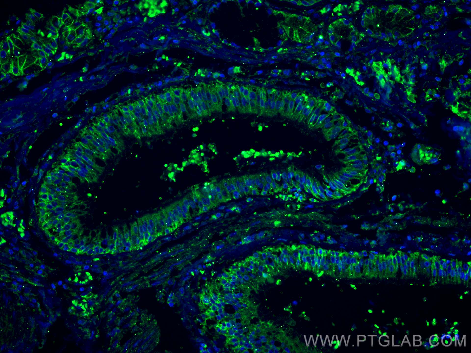 IF Staining of human lung cancer using CL488-60232