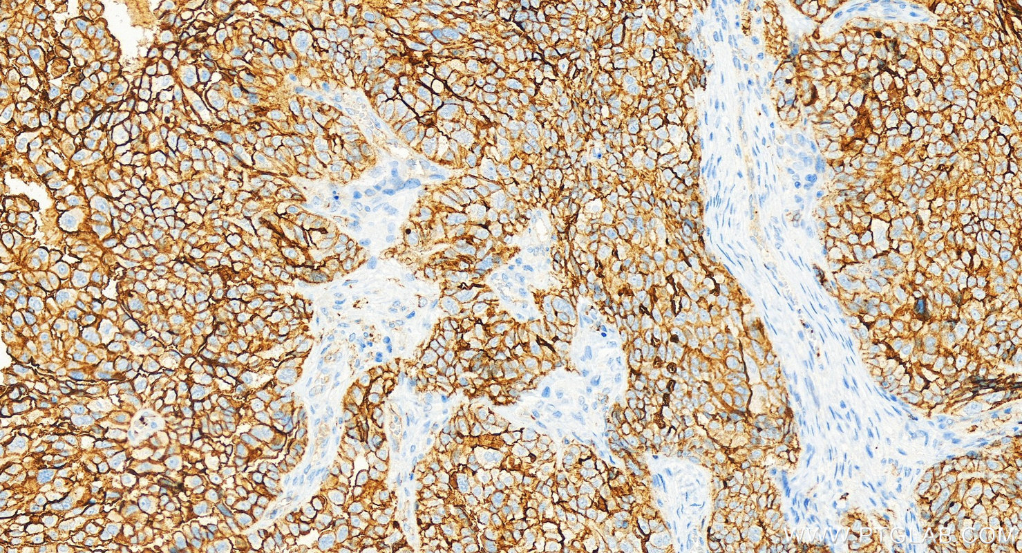 IHC staining of human ovary cancer using RMX00018