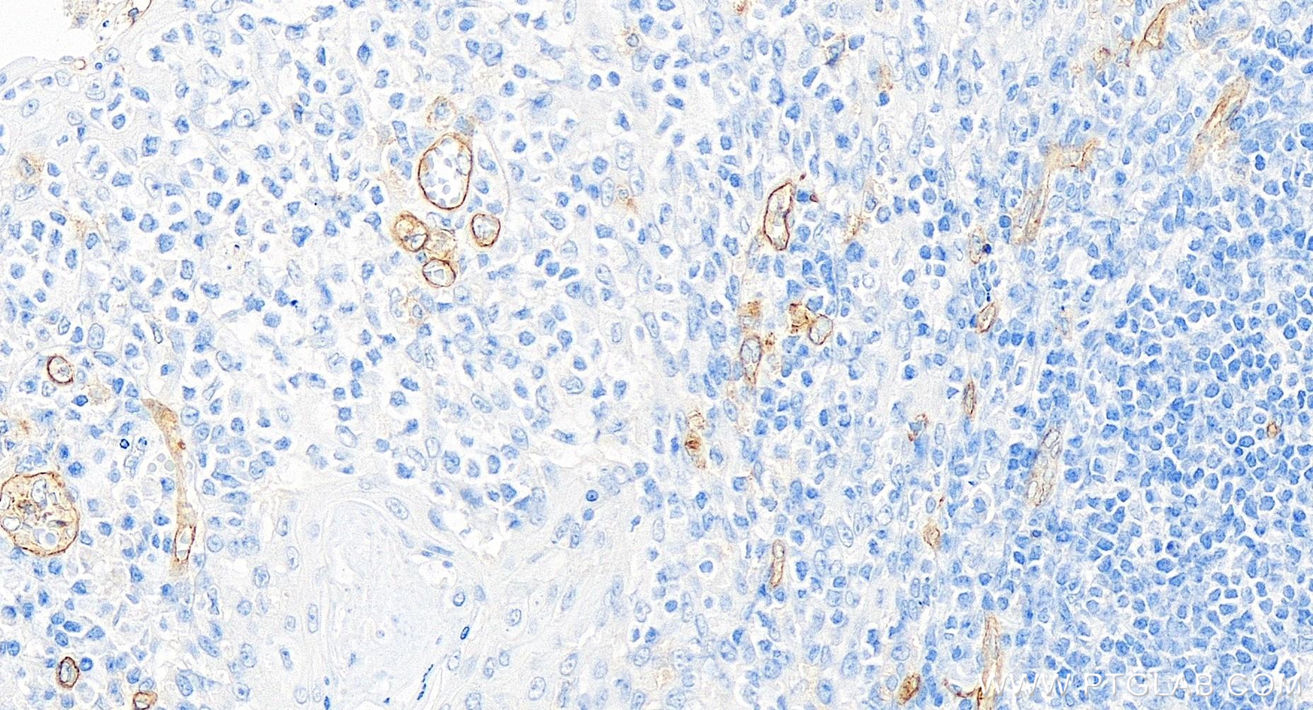 IHC staining of human tonsillitis using 84945-4-RR (same clone as 84945-4-PBS)