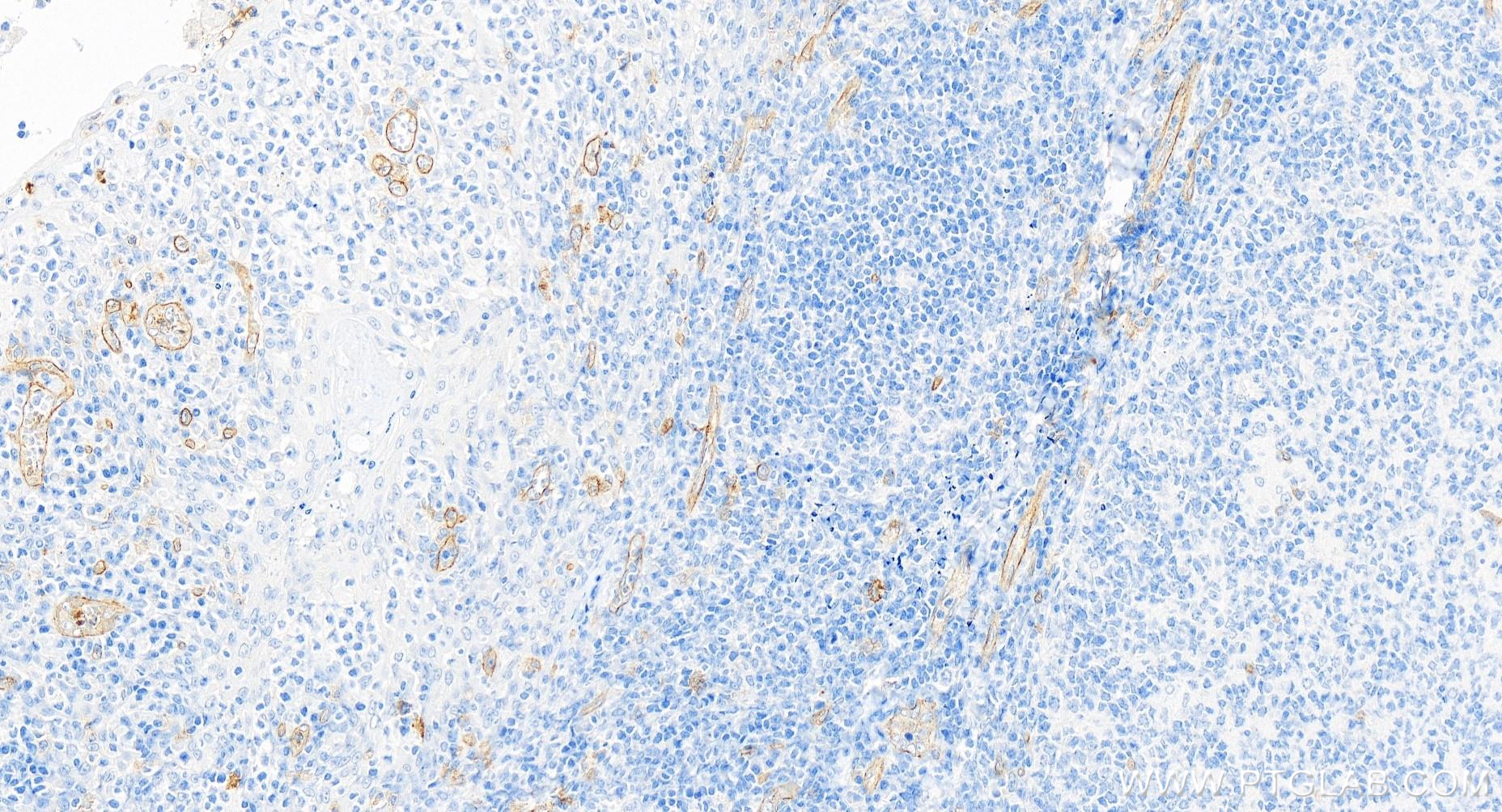 IHC staining of human tonsillitis using 84945-4-RR (same clone as 84945-4-PBS)