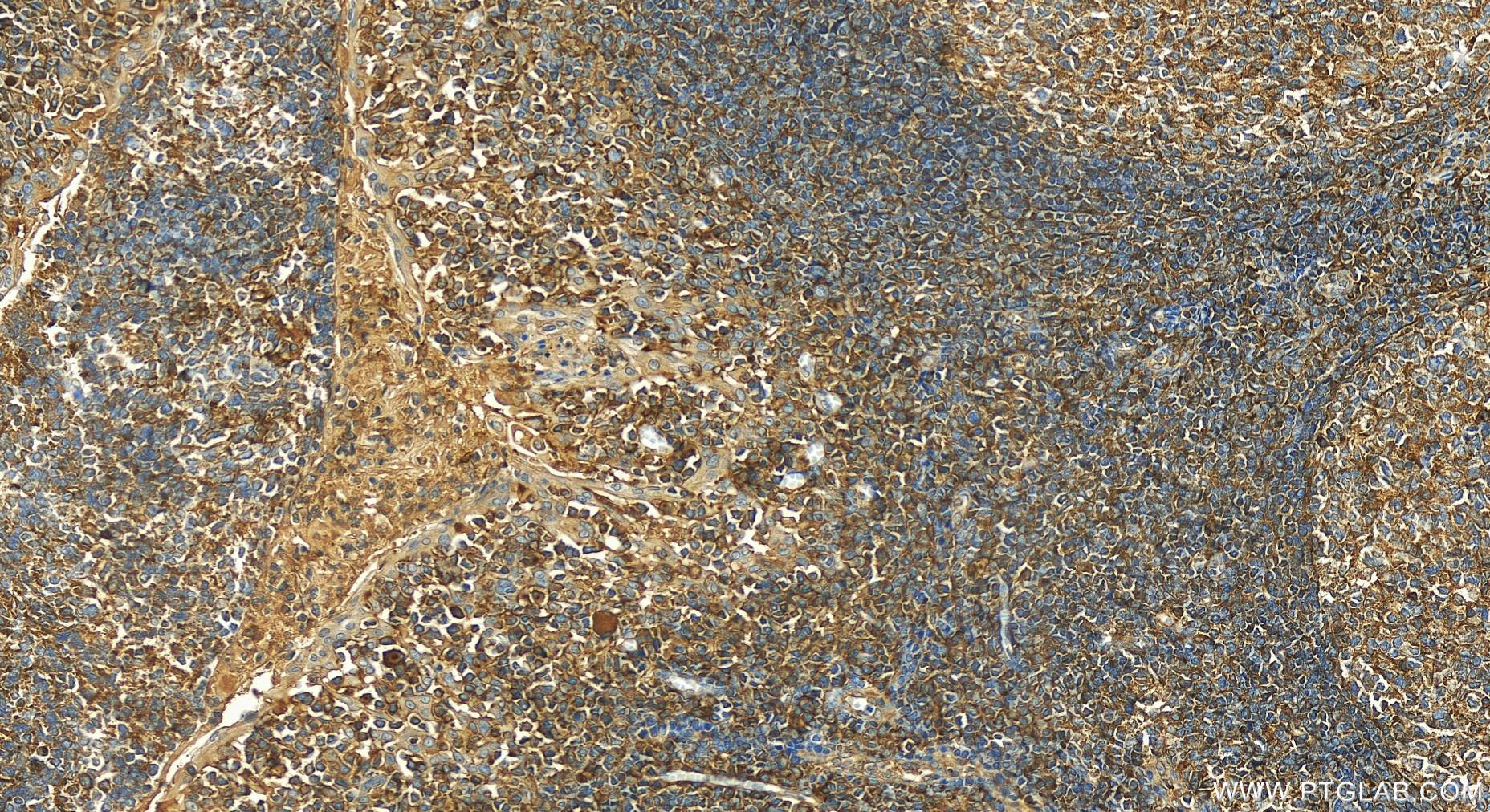 IHC staining of human tonsillitis using 13071-1-AP (same clone as 13071-1-PBS)