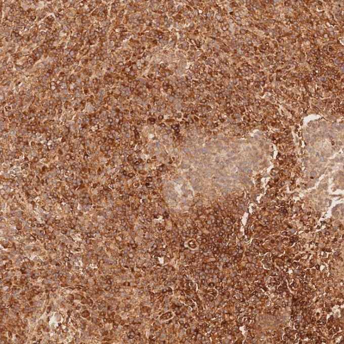 IHC staining of human nasopharyngeal carcinoma using 84580-4-RR IHC staining of human nasopharyngeal carcinoma using 84580-4-RR