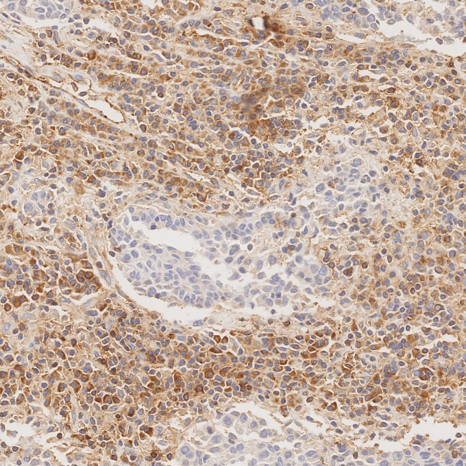 IHC staining of human nasopharyngeal carcinoma using 84580-4-RR IHC staining of human nasopharyngeal carcinoma using 84580-4-RR