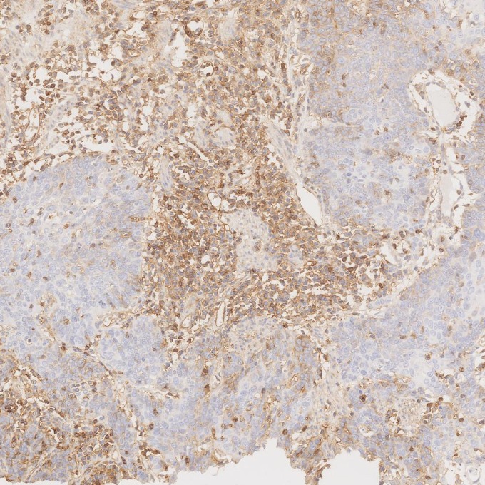 IHC staining of human oesophagus cancer using 84580-4-RR IHC staining of human oesophagus cancer using 84580-4-RR