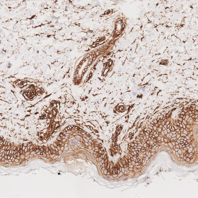 IHC staining of human skin cancer using 84580-4-RR IHC staining of human skin cancer using 84580-4-RR