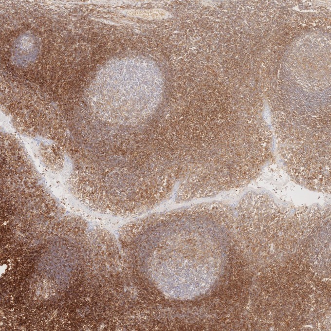 IHC staining of human tonsillitis using 84580-4-RR IHC staining of human tonsillitis using 84580-4-RR