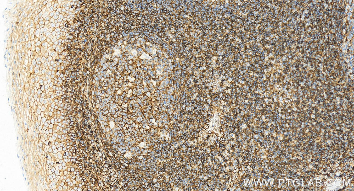 IHC staining of human tonsillitis using 84580-4-RR