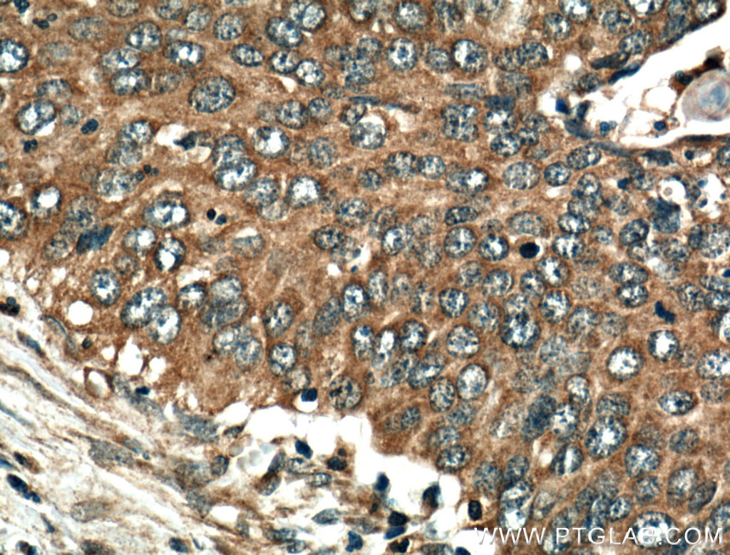 IHC staining of human cervical cancer using 19532-1-AP