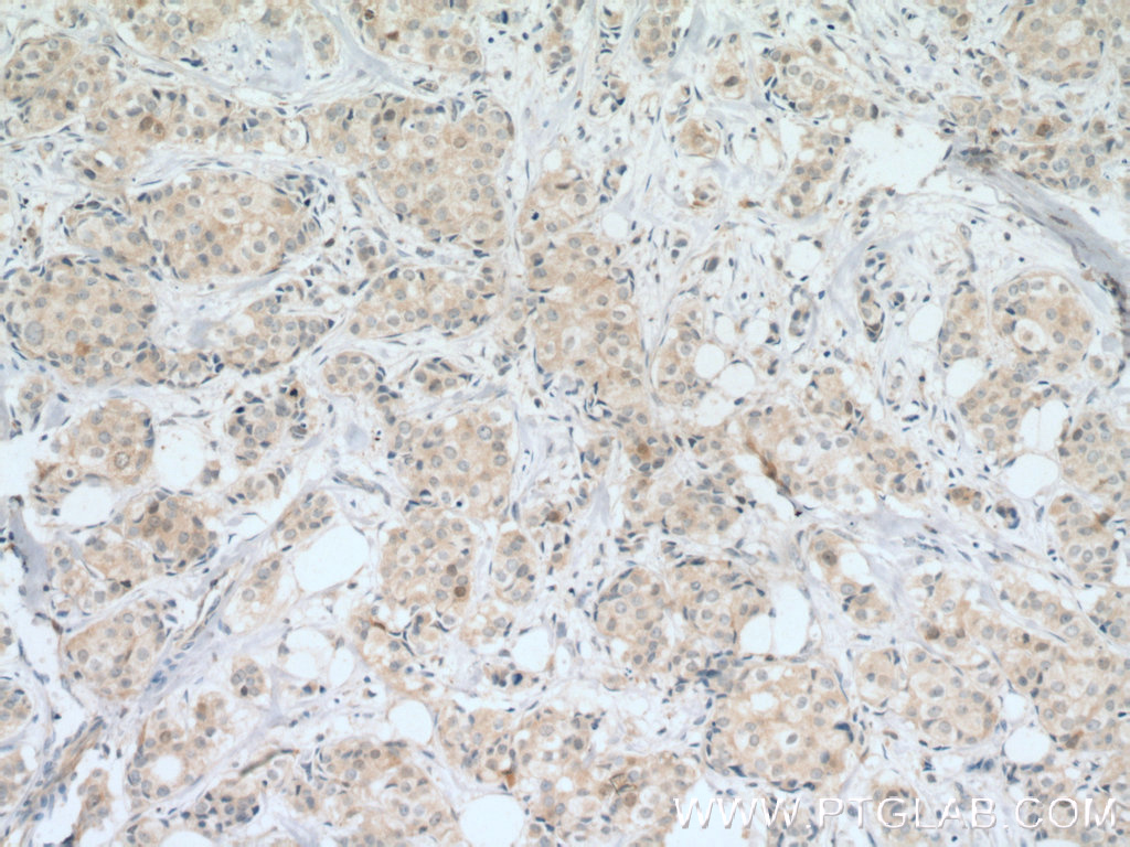 IHC staining of human breast cancer using 10252-1-AP
