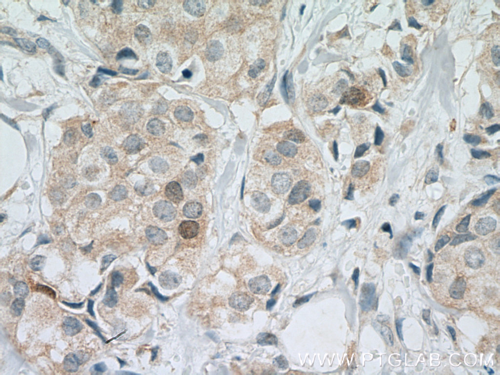 IHC staining of human breast cancer using 10252-1-AP