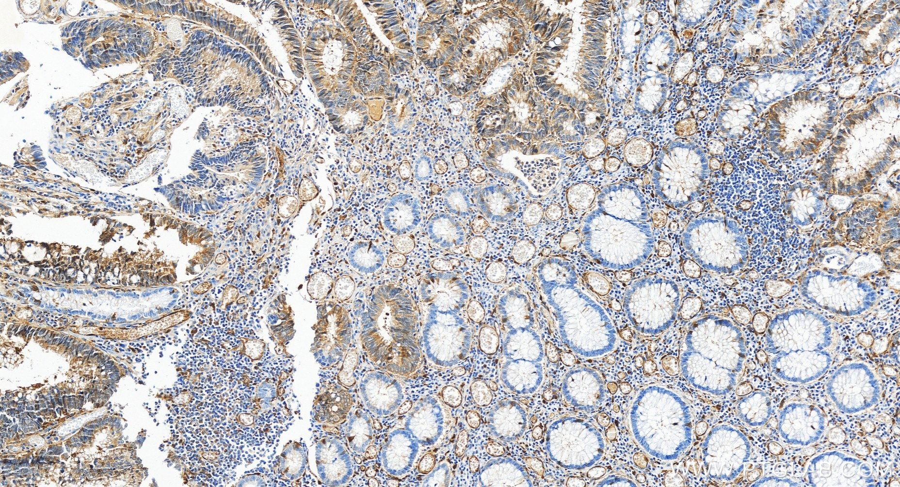IHC staining of human colon cancer using 84531-5-RR (same clone as 84531-5-PBS)