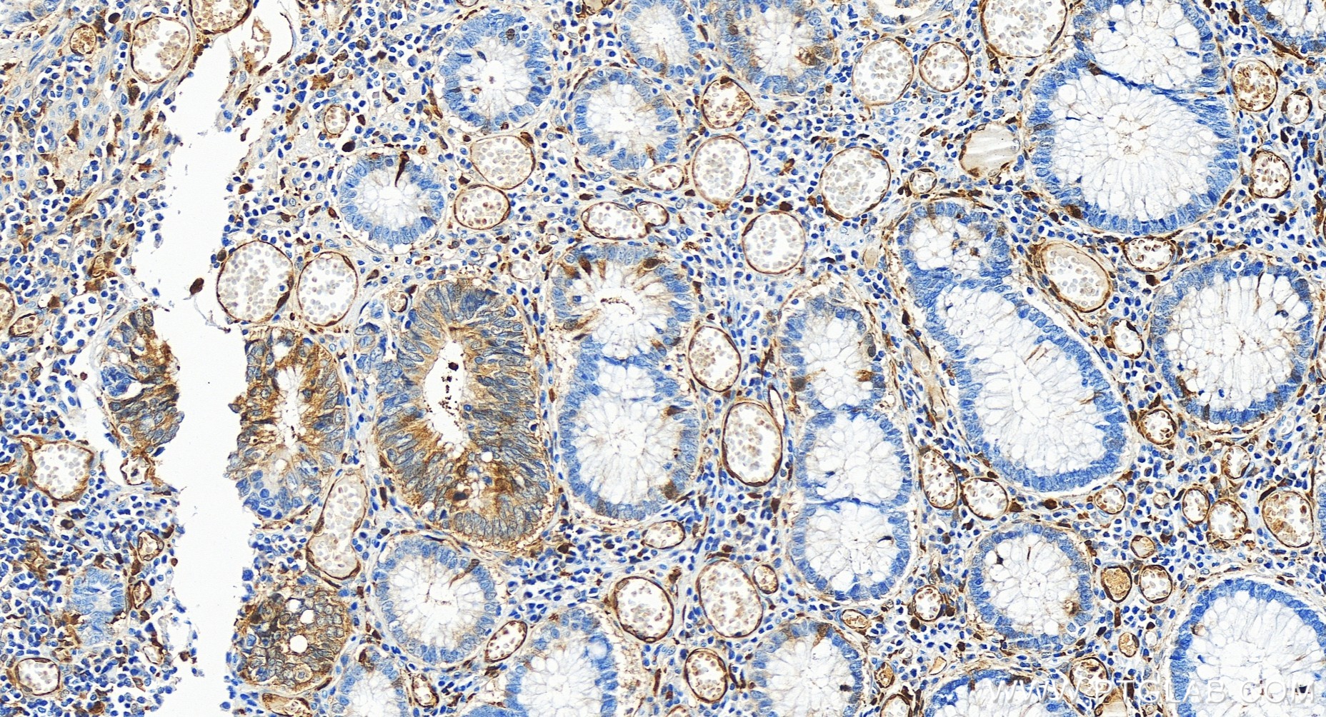 IHC staining of human colon cancer using 84531-5-RR (same clone as 84531-5-PBS)