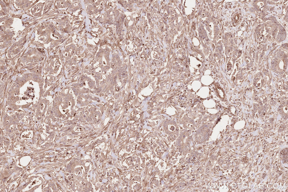IHC staining of human rectal cancer using 13376-1-AP IHC staining of human rectal cancer using 13376-1-AP