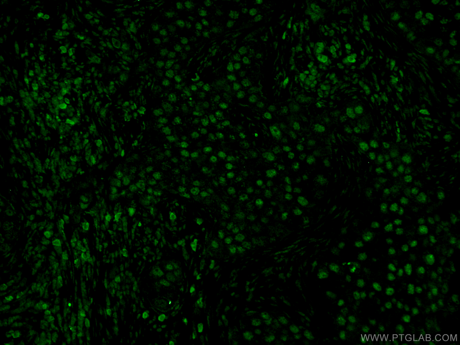 IF Staining of human breast cancer using 55031-1-AP