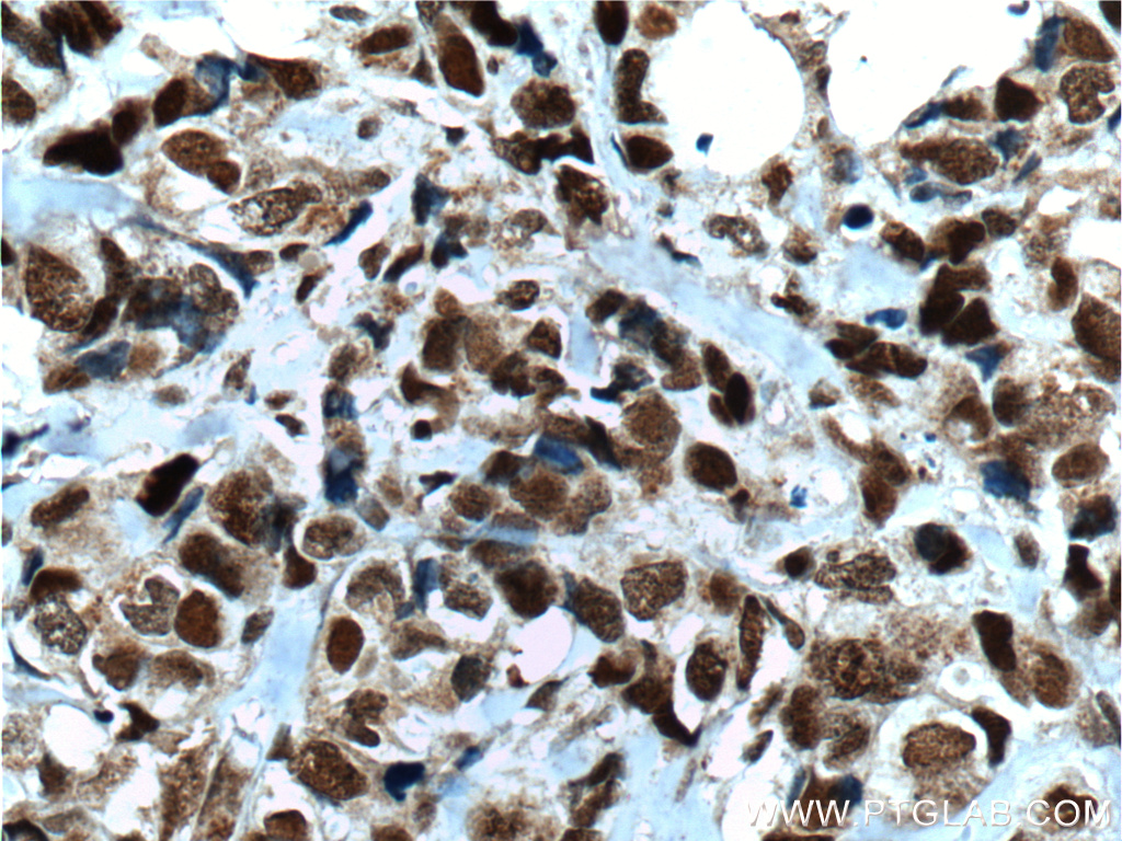 IHC staining of human breast cancer using 55031-1-AP