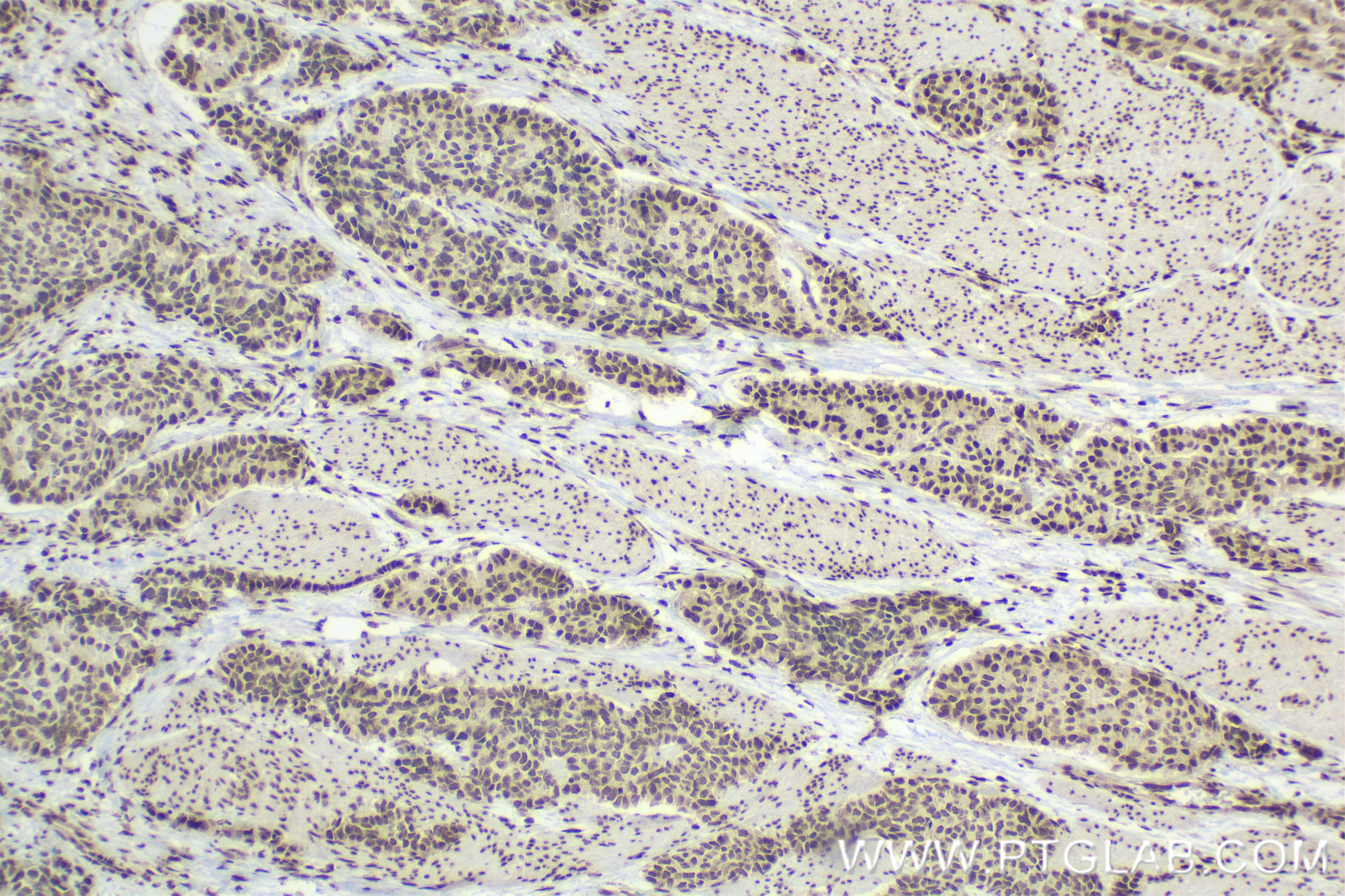 IHC staining of human stomach cancer using 84145-2-RR