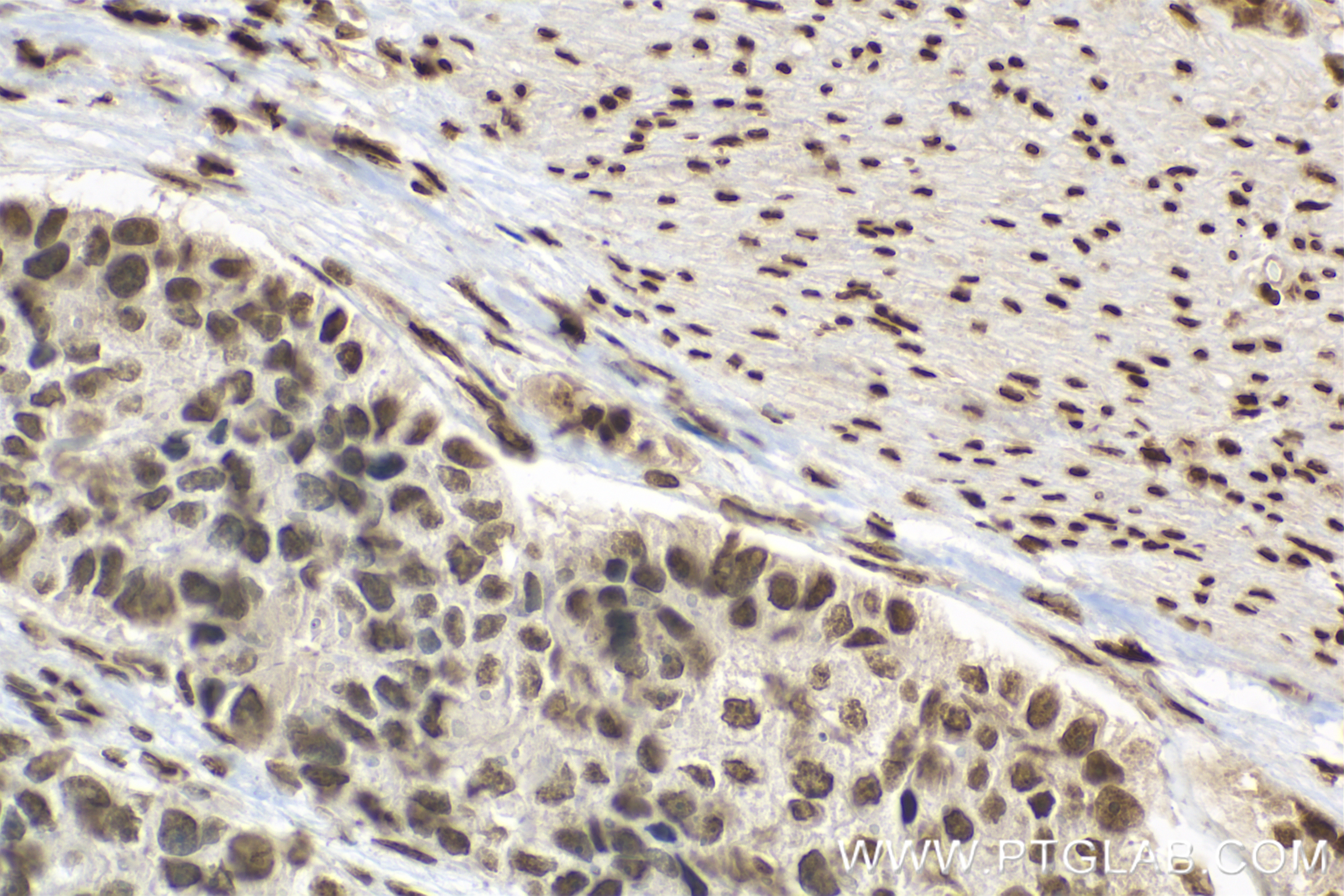 IHC staining of human stomach cancer using 84145-2-RR