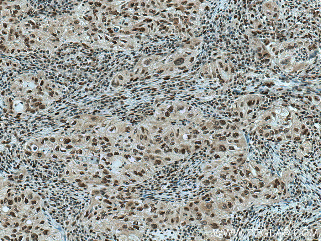 IHC staining of human lung cancer using 67239-1-Ig (same clone as 67239-1-PBS)