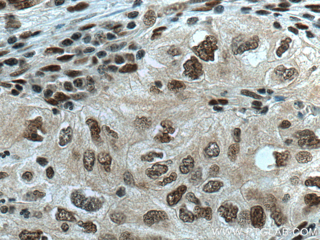 IHC staining of human lung cancer using 67239-1-Ig