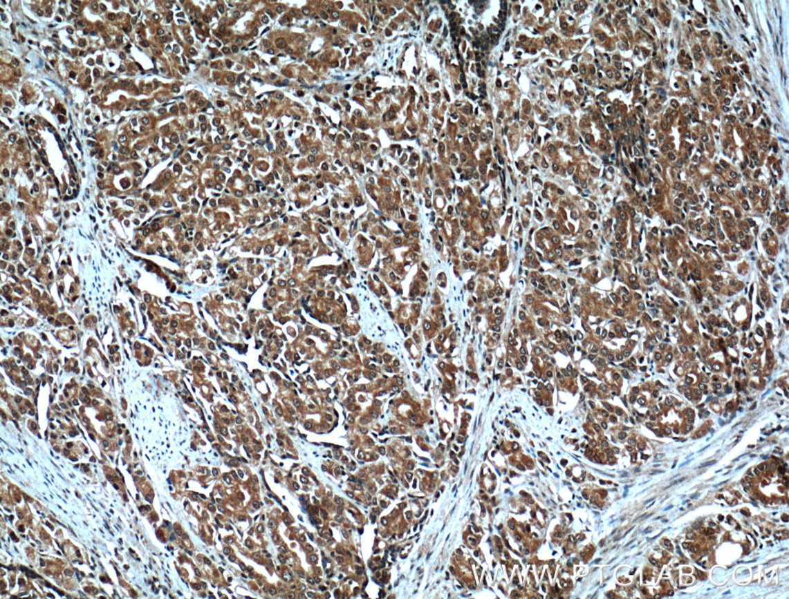 IHC staining of human prostate cancer using 10918-1-AP