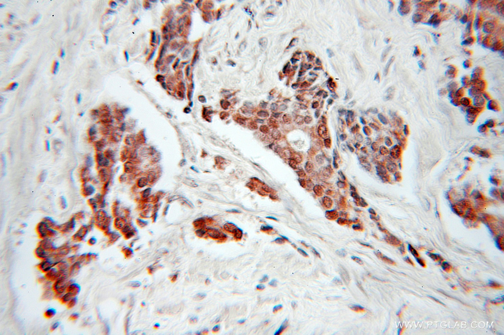 IHC staining of human prostate cancer using 10964-2-AP