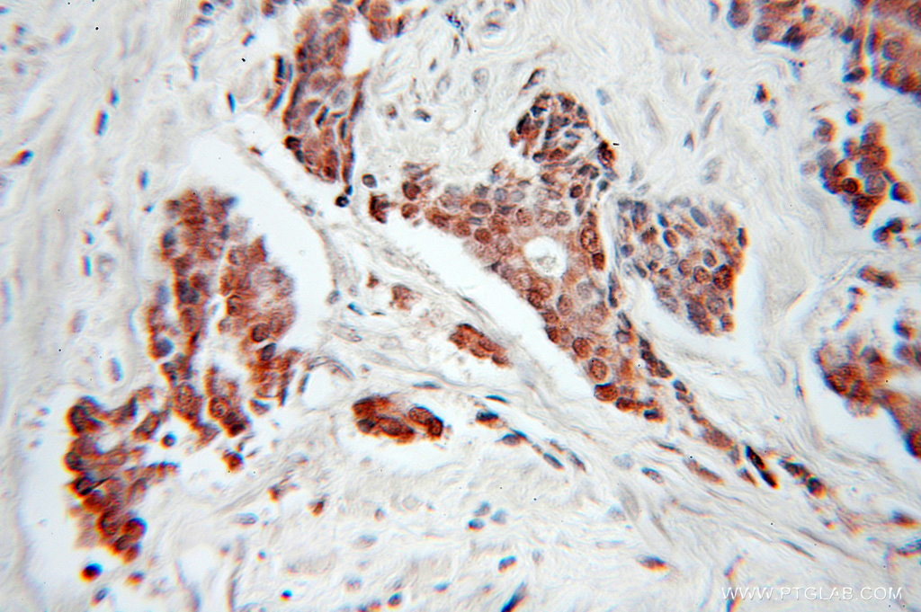 IHC staining of human prostate cancer using 10964-2-AP (same clone as 10964-2-PBS)