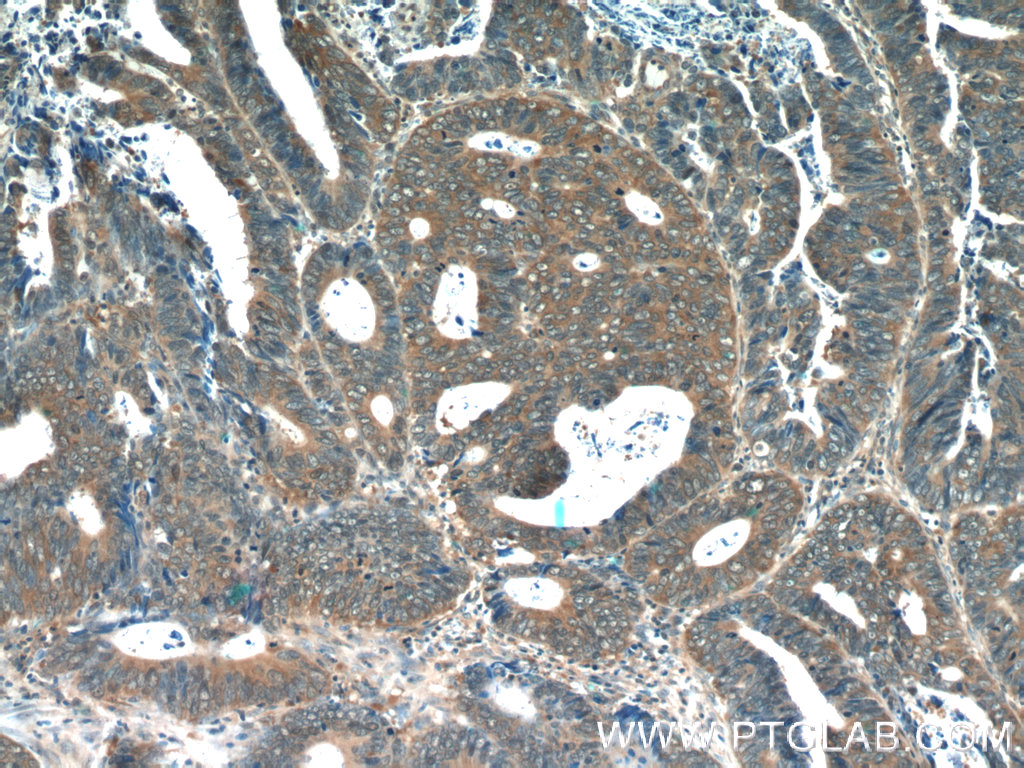 IHC staining of human colon cancer using 10218-1-AP