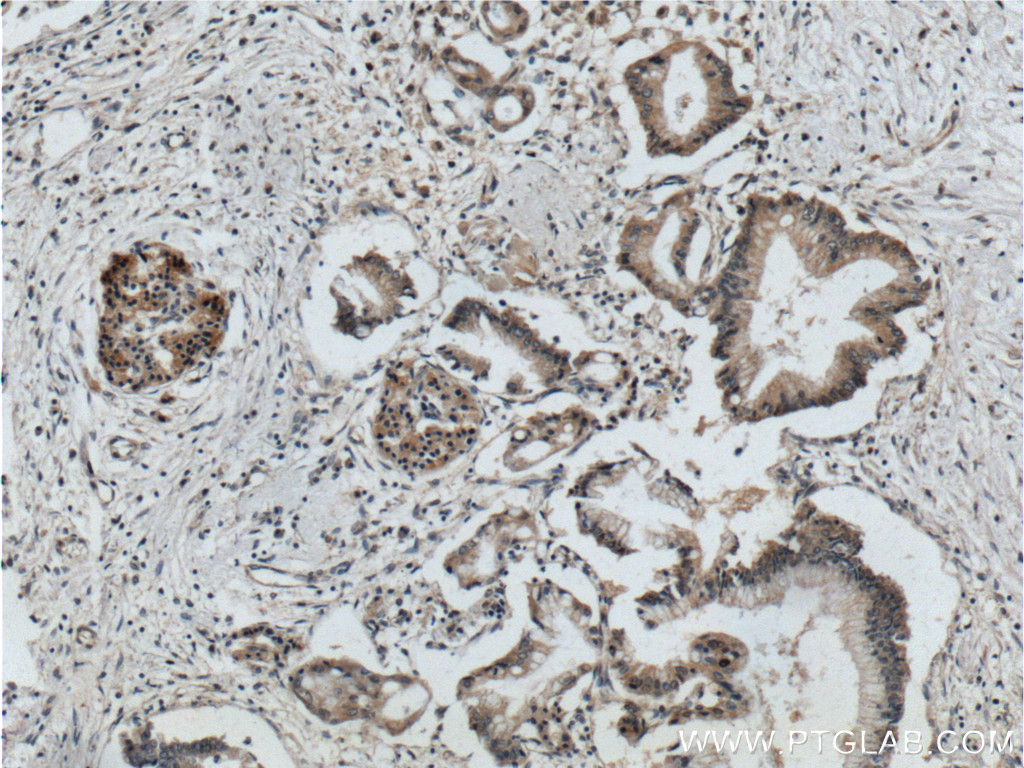 IHC staining of human pancreas cancer using 10155-1-AP