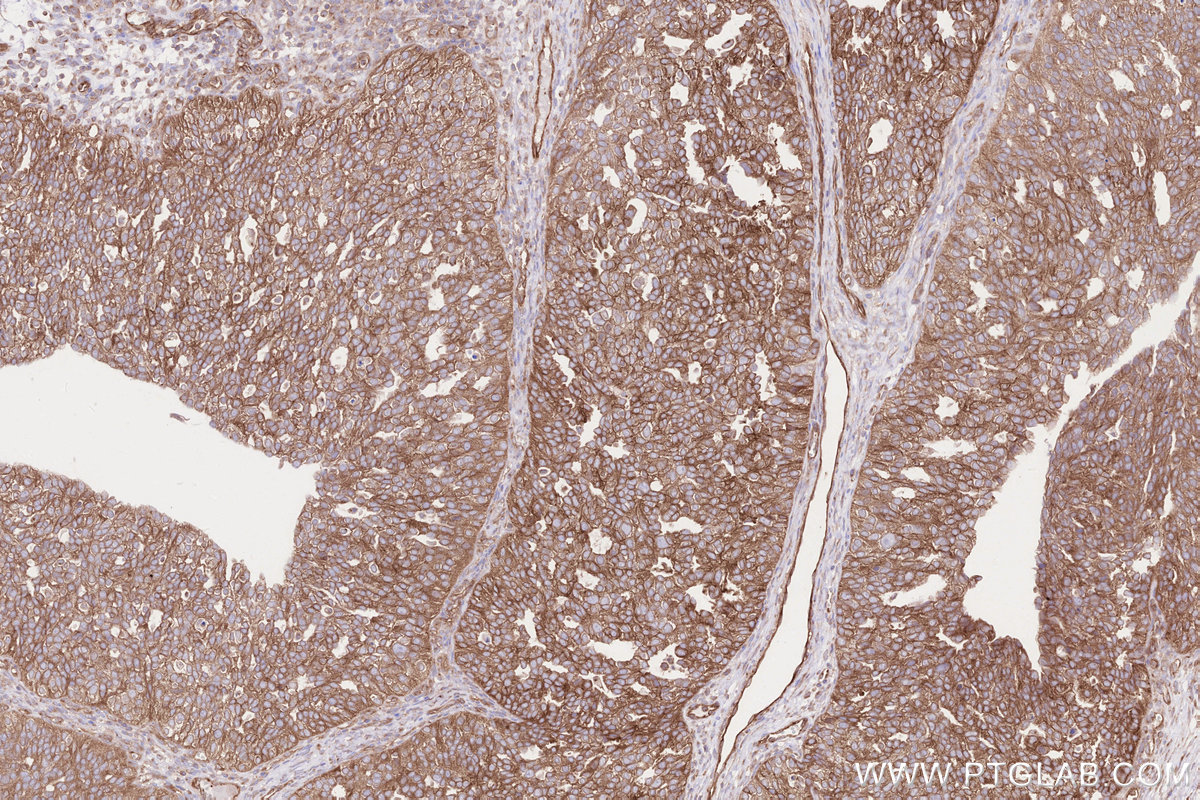 IHC staining of human ovary cancer using 31297-1-AP IHC staining of human ovary cancer using 31297-1-AP