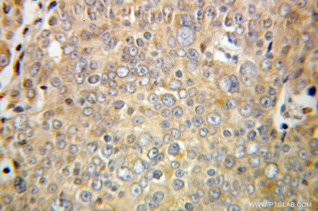 IHC staining of human prostate cancer using 10780-1-AP