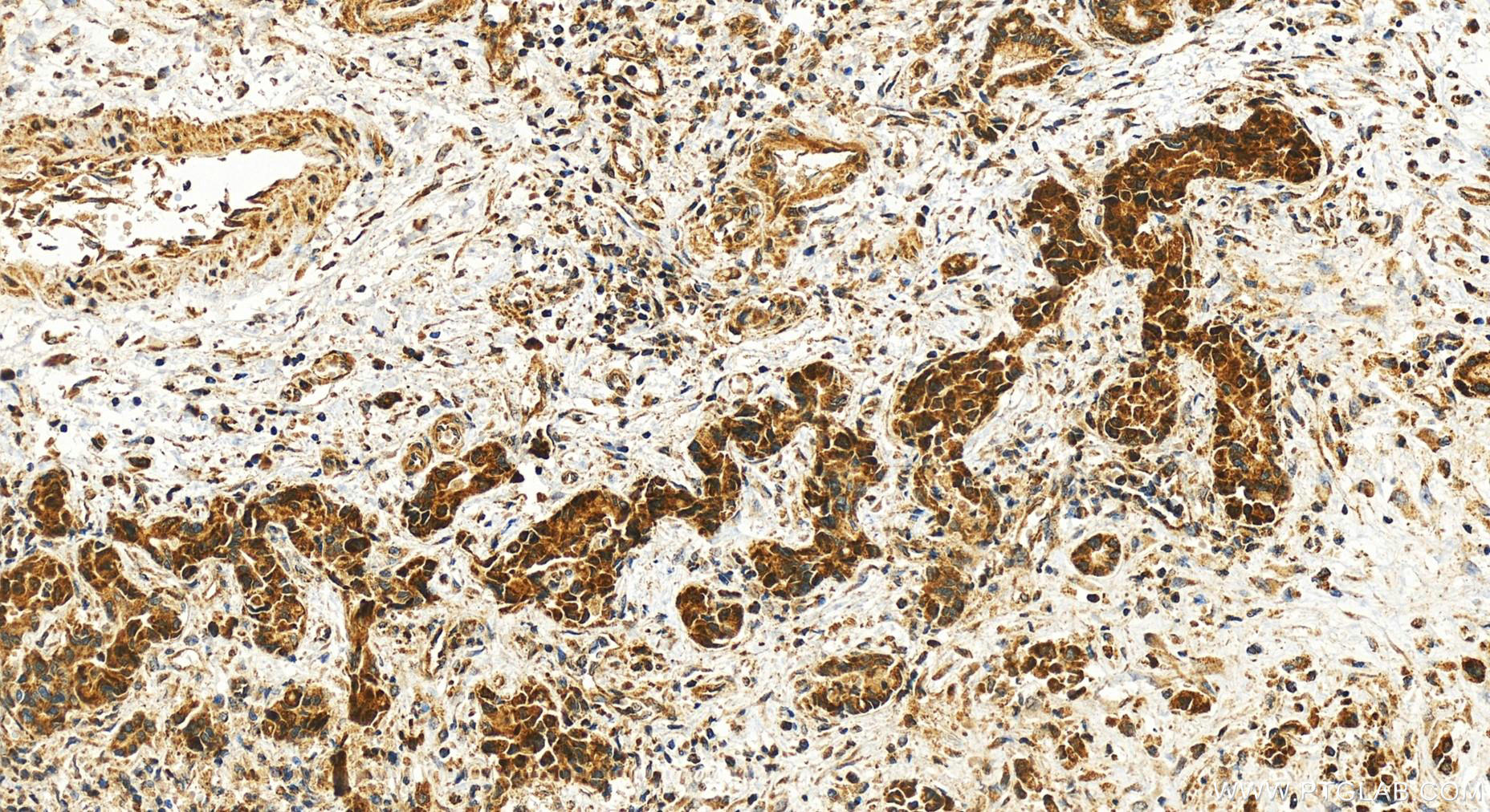 IHC staining of human intrahepatic cholangiocarcinoma using 19262-1-AP
