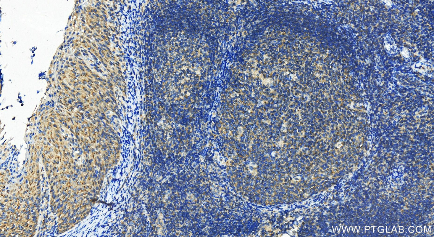 IHC staining of human tonsillitis using 12427-1-AP